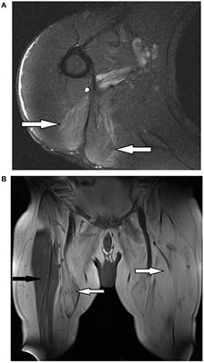 Novel Variants of ANO5 in Two Patients With Limb Girdle Muscular Dystrophy: Case Report